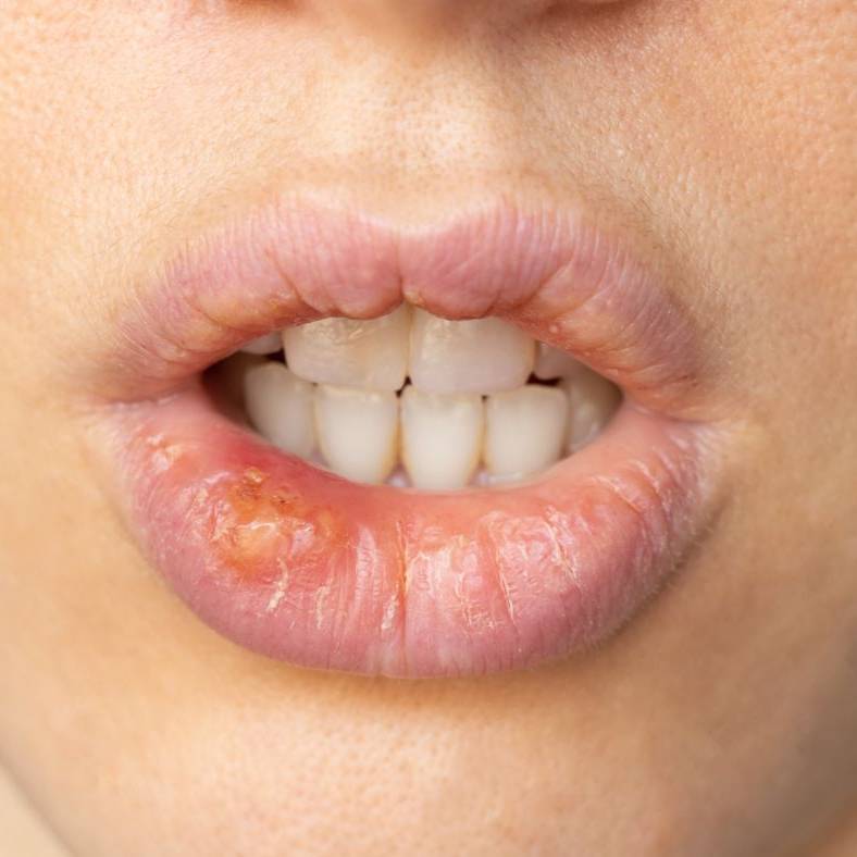 Bitten lip pr tongue