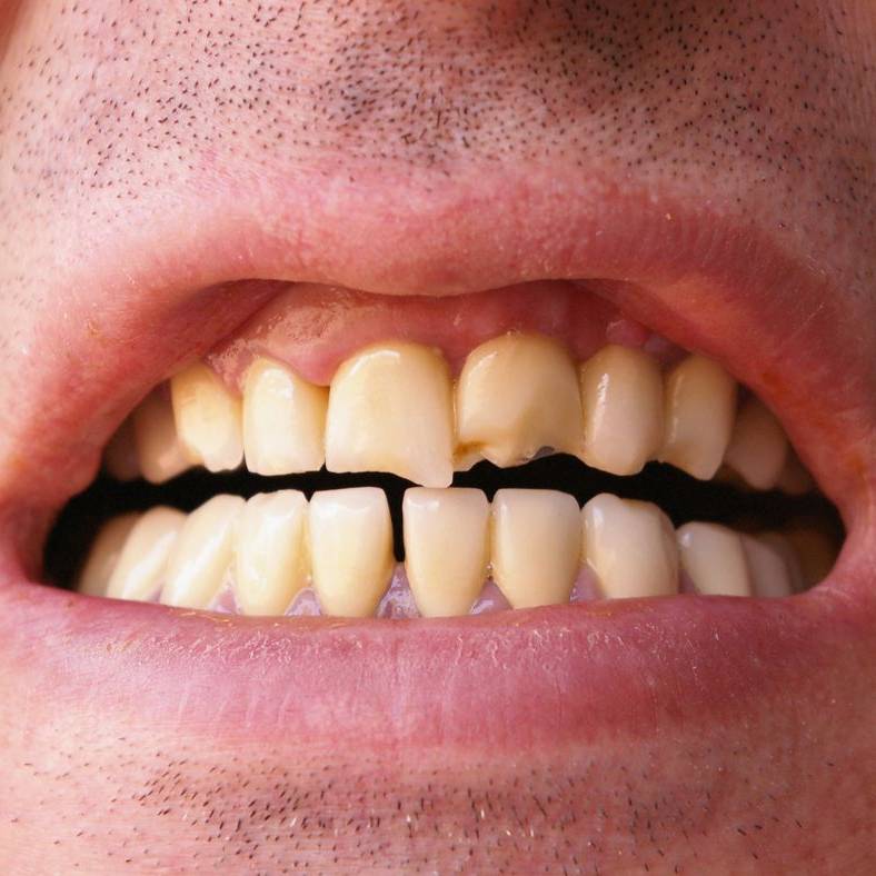 Broken tooth
