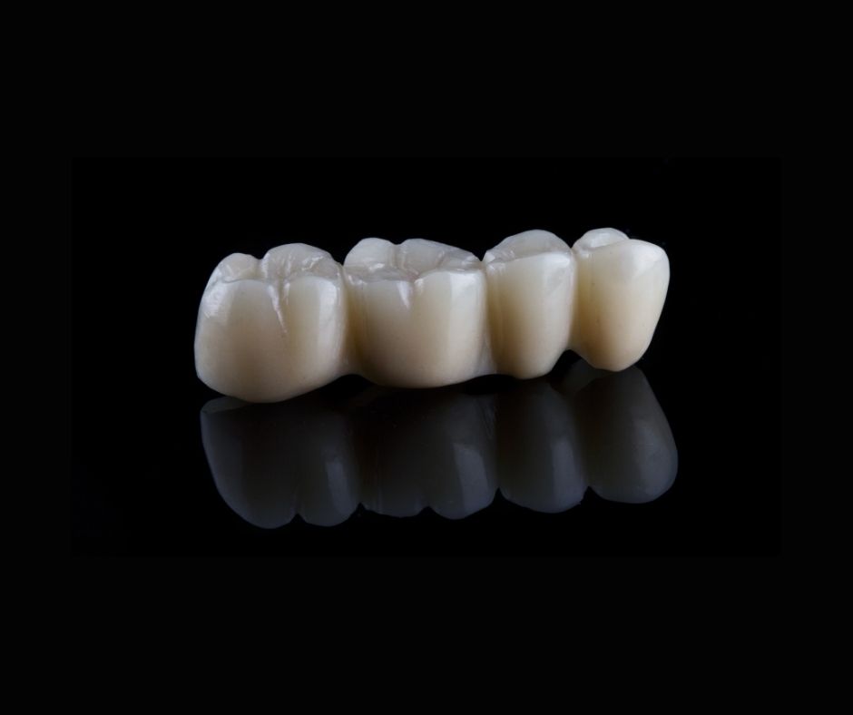 Clinical_Considerations_for_Dental_Bridges__in_Baldivis[1]
