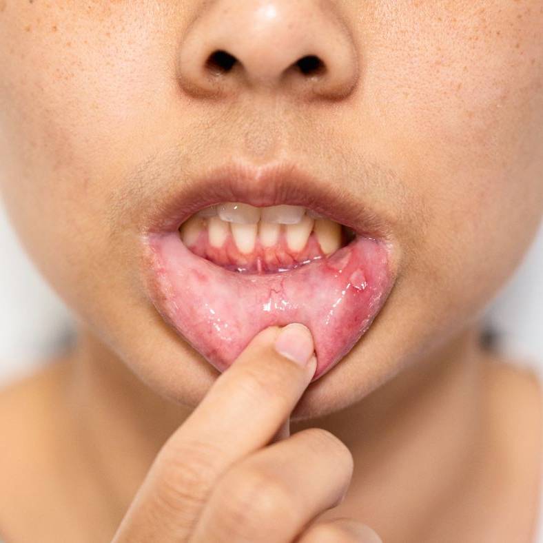 Soreness from braces or retainers
